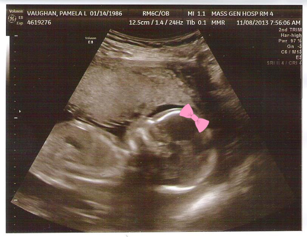 week 18 sonogram