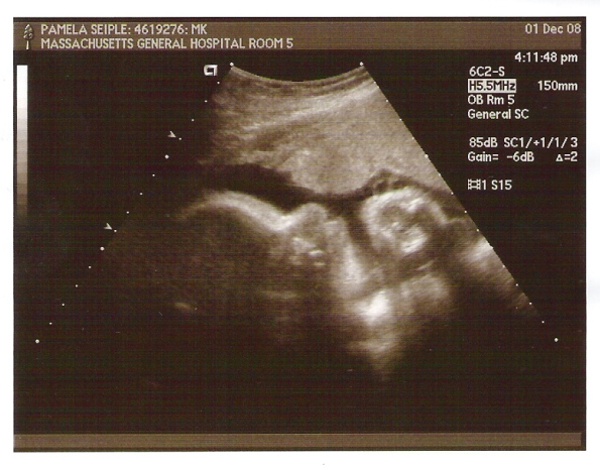 Emmett 34 weeks