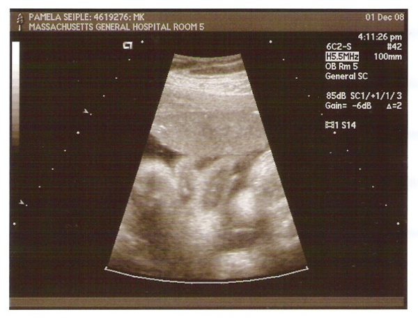 Emmett 34 weeks