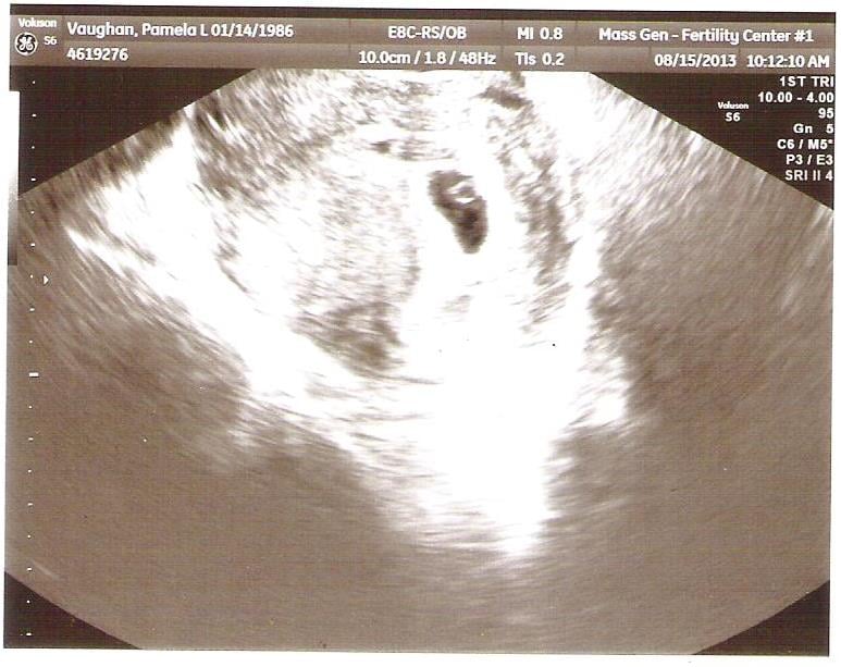 6 week sonogram