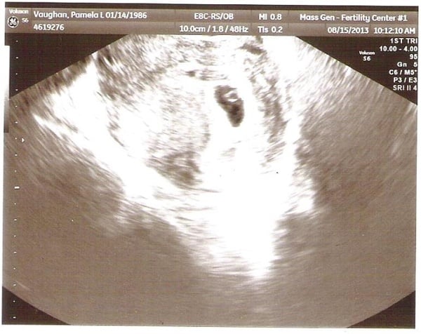 6 week sonogram