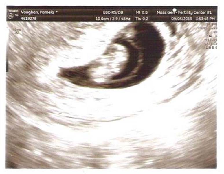 9 week sonogram